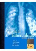 DAVIES, PETER DO – BARNES, PETER, F – GORDON, STEPHEN B (ed) - Clinical Tuberculosis