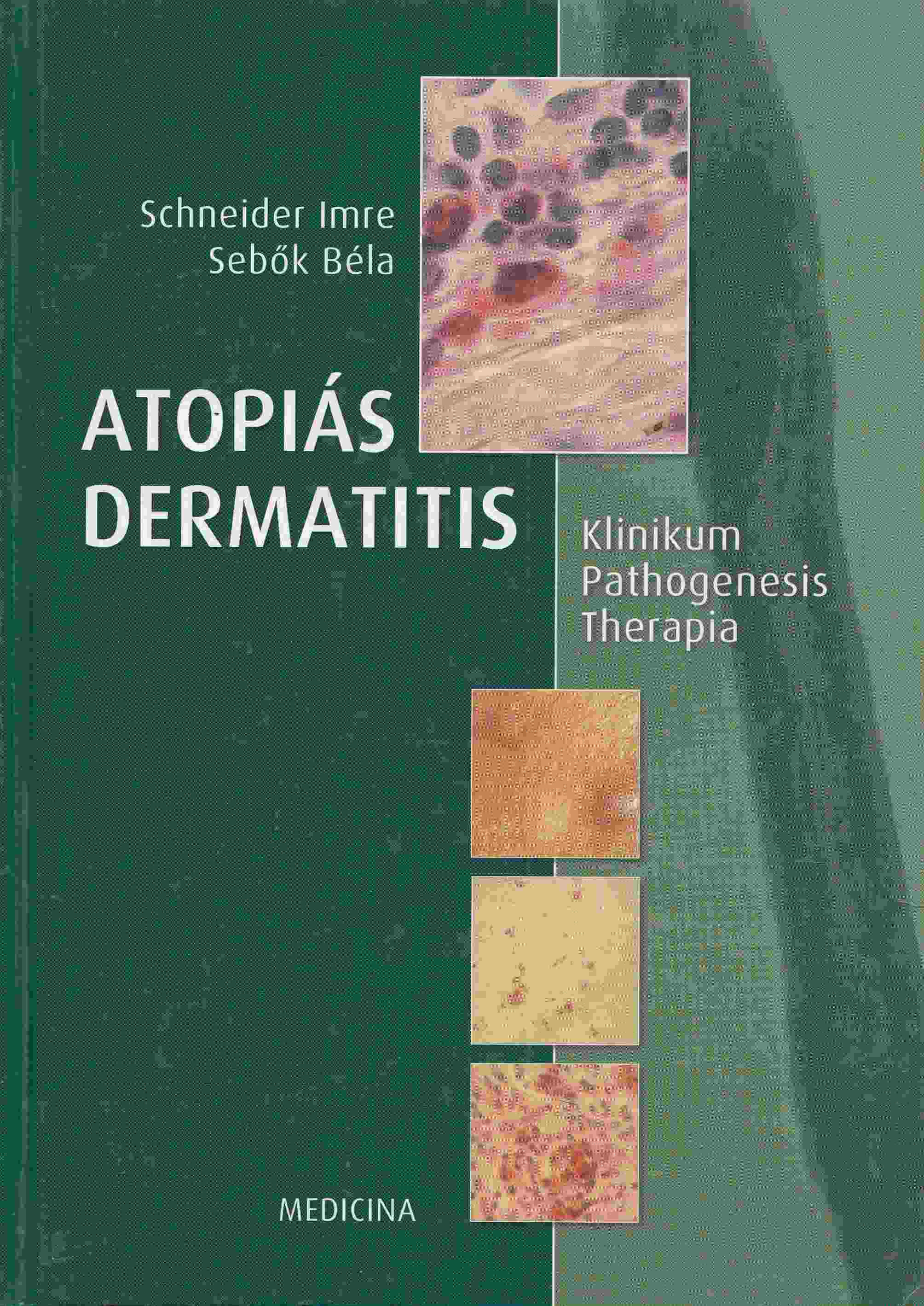 Schneider Imre, Sebők Béla - Atopiás dermatitis Schneider Imre, Sebők Béla - Atopiás dermatitis, Budapest 2005 antikvár könyv