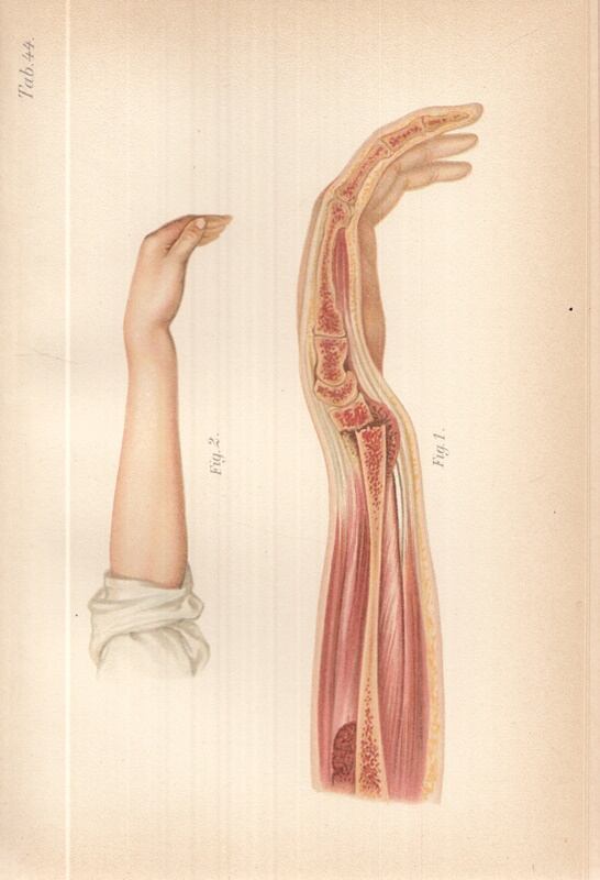 Helferich, Heinrich - A traumaticus törések és ficzamodások alapvonalai és atlasza (1898), Budapest 1898 antikvár könyv